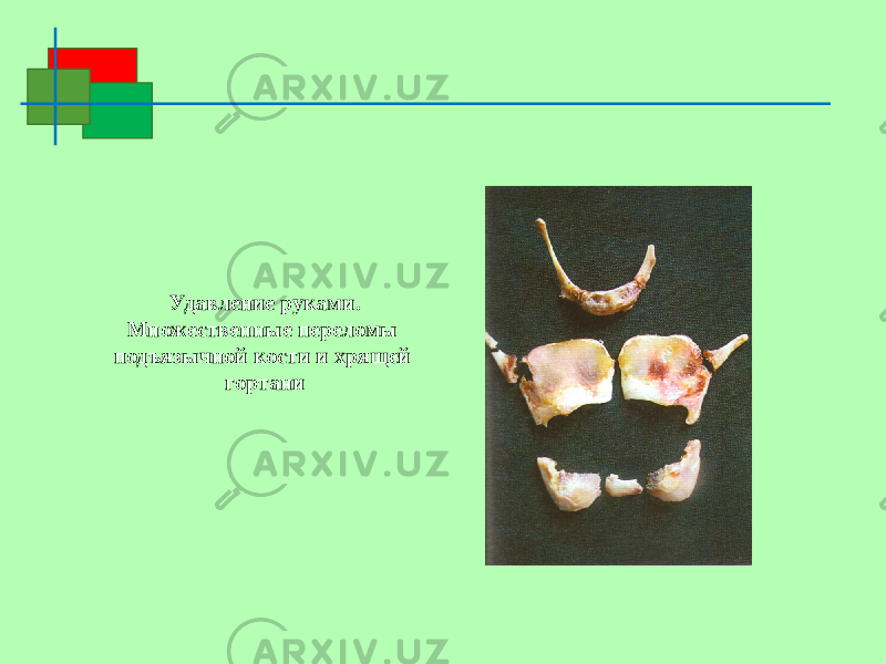 Удавление руками. Множественные переломы подъязычной кости и хрящей гортани 