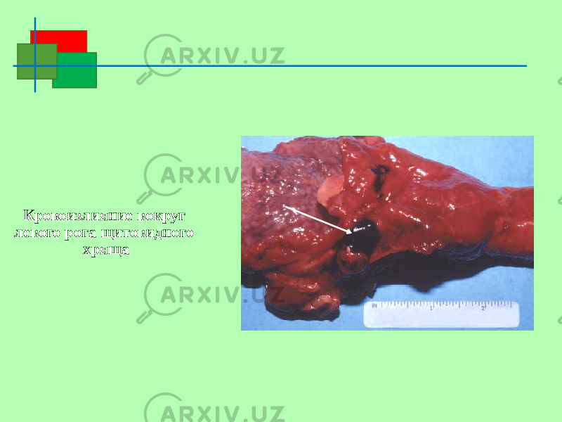  Кровоизлияние вокруг левого рога щитовидного хряща 