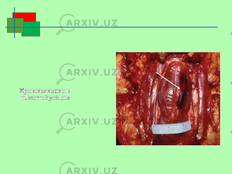 Кровоизлияние в m. sternohyoideus 