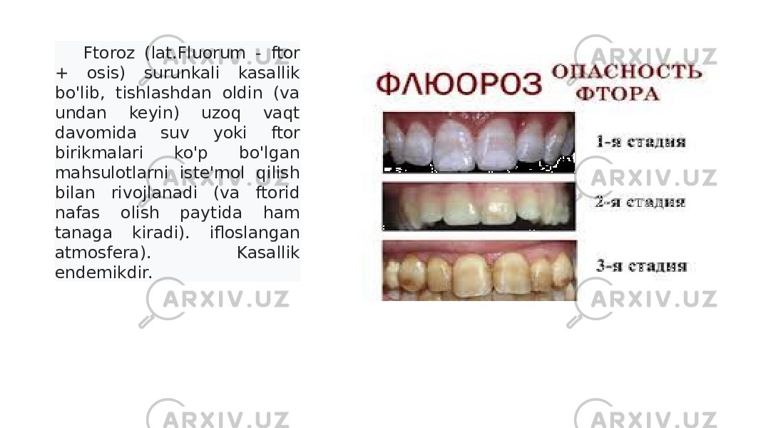 Ftoroz (lat.Fluorum - ftor + osis) surunkali kasallik bo&#39;lib, tishlashdan oldin (va undan keyin) uzoq vaqt davomida suv yoki ftor birikmalari ko&#39;p bo&#39;lgan mahsulotlarni iste&#39;mol qilish bilan rivojlanadi (va ftorid nafas olish paytida ham tanaga kiradi). ifloslangan atmosfera). Kasallik endemikdir. 