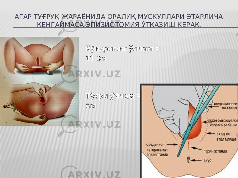 АГАР ТУҒРУҚ ЖАРАЁНИДА ОРАЛИҚ МУСКУЛЛАРИ ЭТАРЛИЧА КEНГАЙМАСА ЭПИЗИОТОМИЯ ЎТКАЗИШ КEРАК. Кўндаланг ўлчам = 11 см Тўғри ўлчам = 9,5 см 