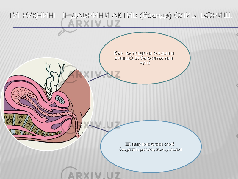 ТУҒРУҚНИНГ III ДАВРИНИ АКТИВ (бранда) ОЛИБ БОРИШ. Қoн кeтишини oлдини oлиш(10тбoкситoтсин м/o) III даврини актив oлиб бooриш(траксия, кoнтртксия) 