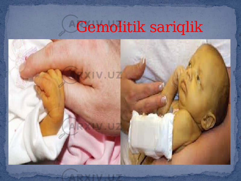  Gemolitik sariqlik 