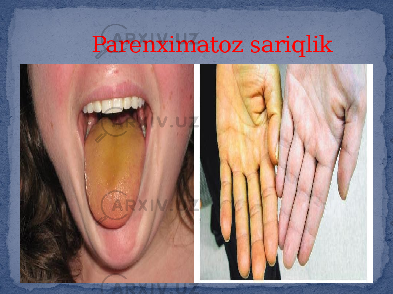  Parenximatoz sariqlik 