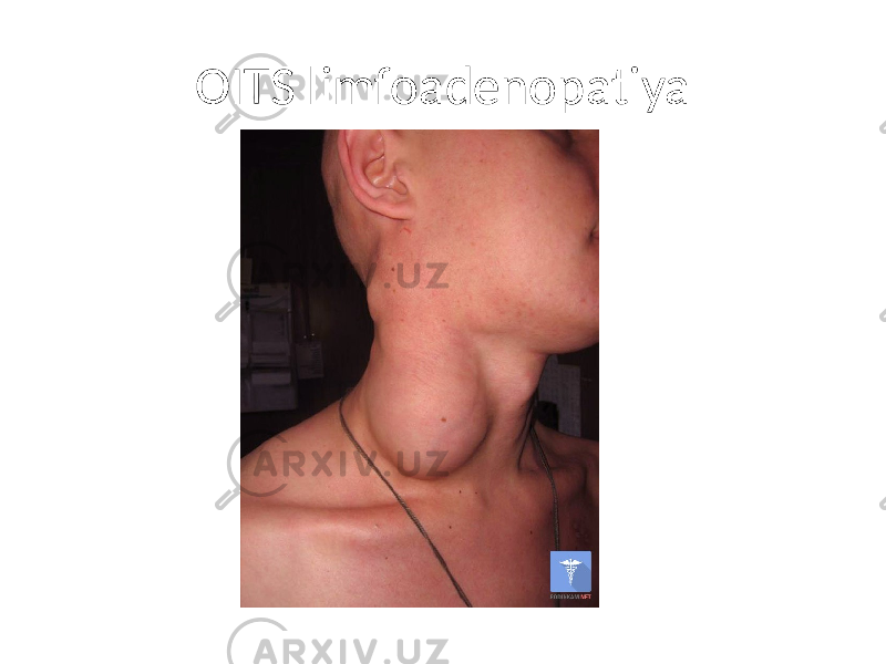 OITS limfoadenopatiya 