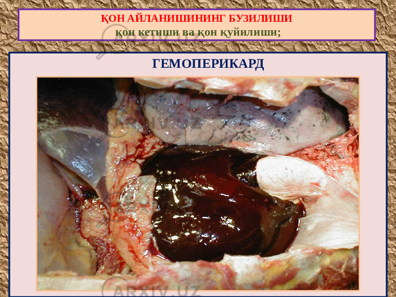  ГЕМОПЕРИКАРДҚОН АЙЛАНИШИНИНГ БУЗИЛИШИ қон кетиши ва қон қуйилиши; 