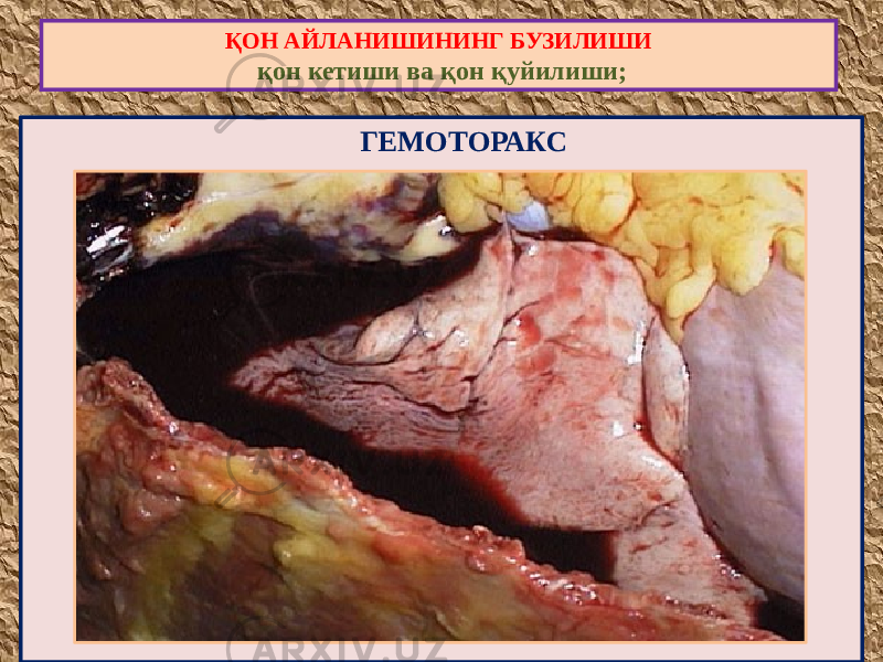  ГЕМОТОРАКСҚОН АЙЛАНИШИНИНГ БУЗИЛИШИ қон кетиши ва қон қуйилиши; 