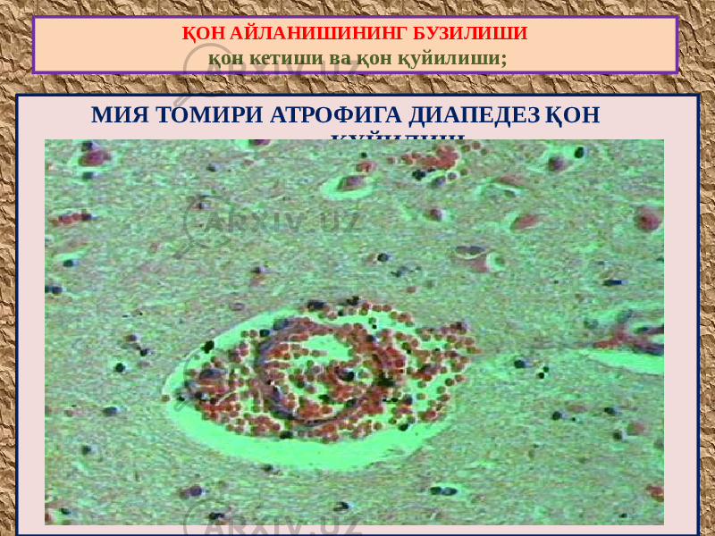  МИЯ ТОМИРИ АТРОФИГА ДИАПЕДЕЗ ҚОН ҚУЙИЛИШҚОН АЙЛАНИШИНИНГ БУЗИЛИШИ қон кетиши ва қон қуйилиши; 