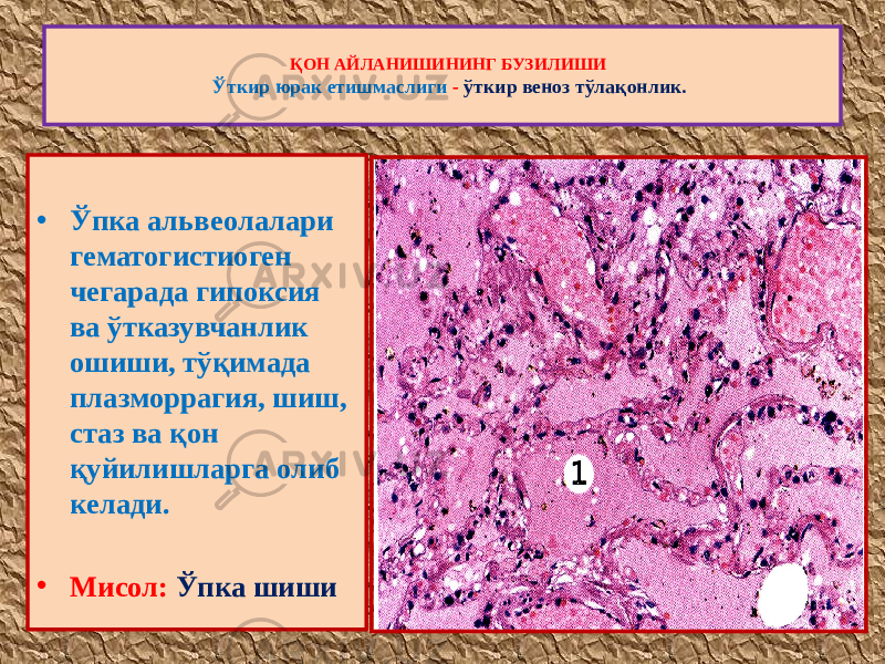 • Ўпка альвеолалари гематогистиоген чегарада гипоксия ва ўтказувчанлик ошиши, тўқимада плазморрагия, шиш, стаз ва қон қуйилишларга олиб келади. • Мисол: Ўпка шиши ҚОН АЙЛАНИШИНИНГ БУЗИЛИШИ Ўткир юрак етишмаслиги - ўткир веноз тўлақонлик. 