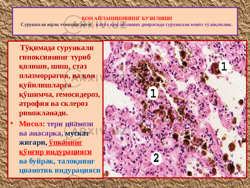  Тўқимада сурункали гипоксиянинг туриб қолиши, шиш, стаз плазморрагия, ва қон қуйилишларга қўшимча, гемосидероз, атрофия ва склероз ривожланади. • Мисол: тери цианози ва анасарка, мускат жигари, ўпканинг қўнғир индурацияси ва буйрак, талоқнинг цианотик индурацияси ҚОН АЙЛАНИШИНИНГ БУЗИЛИШИ Сурункали юрак етишмаслиги – катта қон айланиш доирасида сурункали веноз тўлақонлик. 