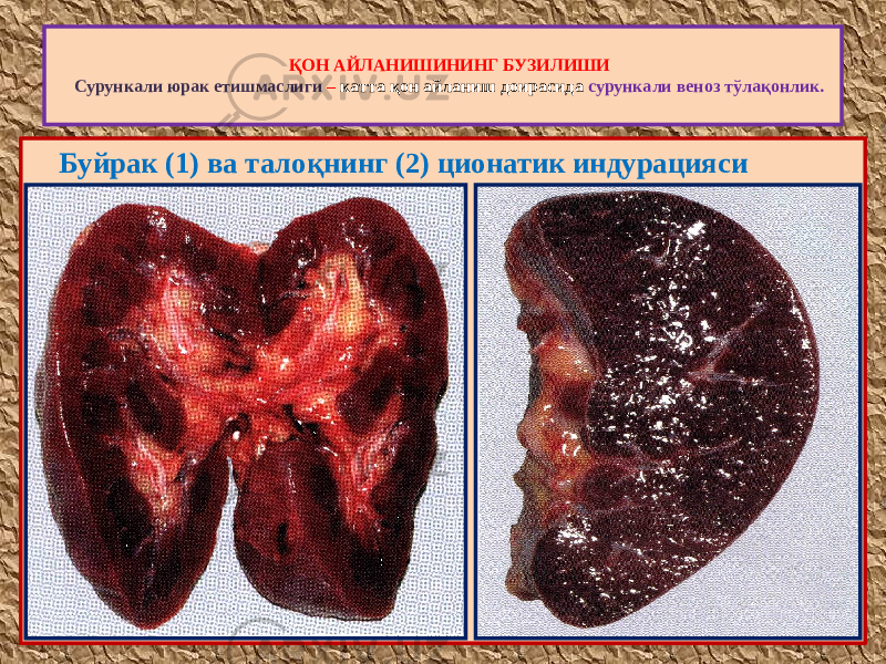  Буйрак (1) ва талоқнинг (2) ционатик индурацияси ҚОН АЙЛАНИШИНИНГ БУЗИЛИШИ Сурункали юрак етишмаслиги – катта қон айланиш доирасида сурункали веноз тўлақонлик. 