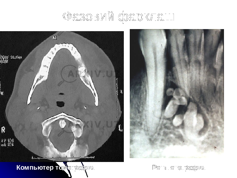 Фазовий фарклаш Компьютер томография Рентгенография 