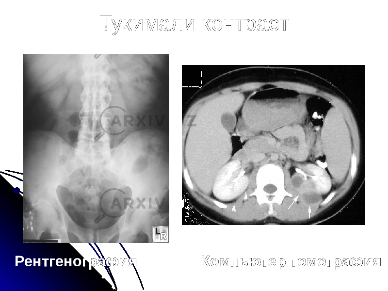 Тукимали контраст Рентгенография Компьютер томография 