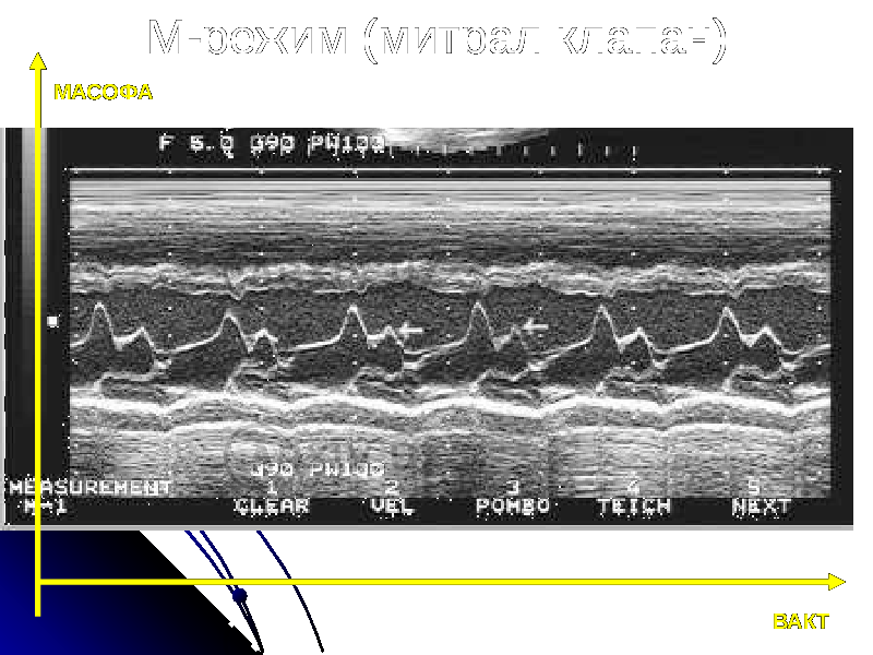 М-режим (митрал клапан) ВАКТМАСОФА 