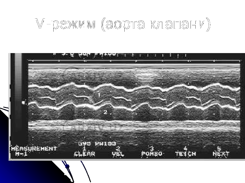 М-режим (аорта клапани) 