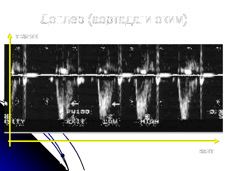 Доплер (аортадаги оким) ВАКТТЕЗЛИК 