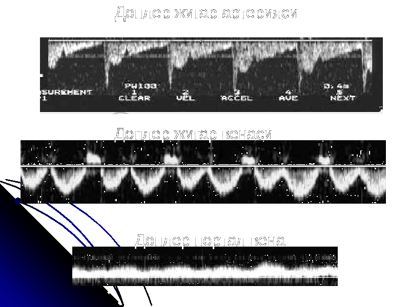 Доплер жигар артерияси Доплер жигар венаси Доплер портал вена 