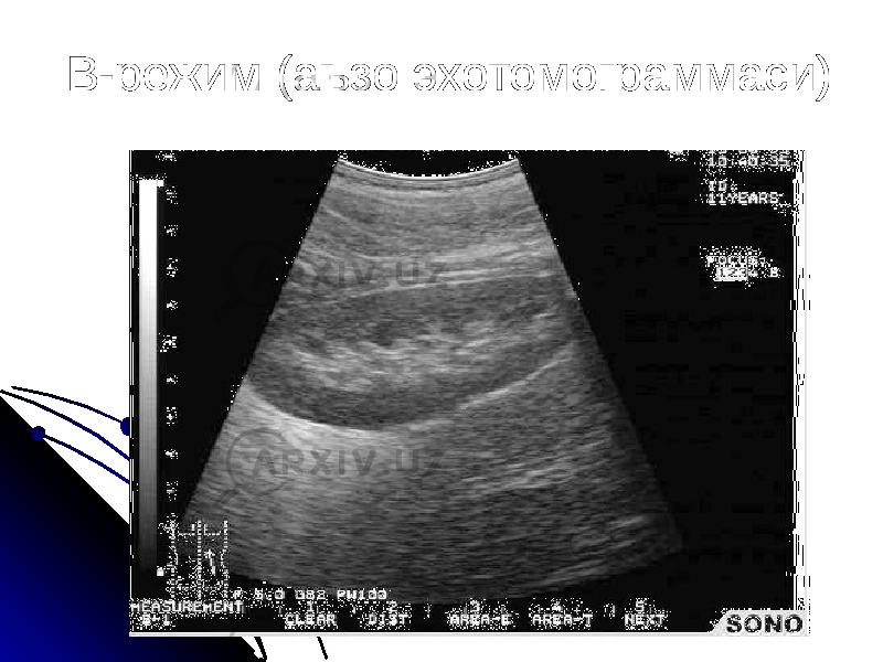 В-режим (аъзо эхотомограммаси) 