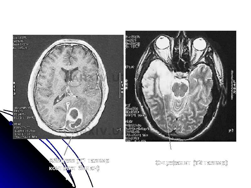 Абсцесс (Т1 тасвир контраст билан) Энцефалит (Т2 тасвир) 