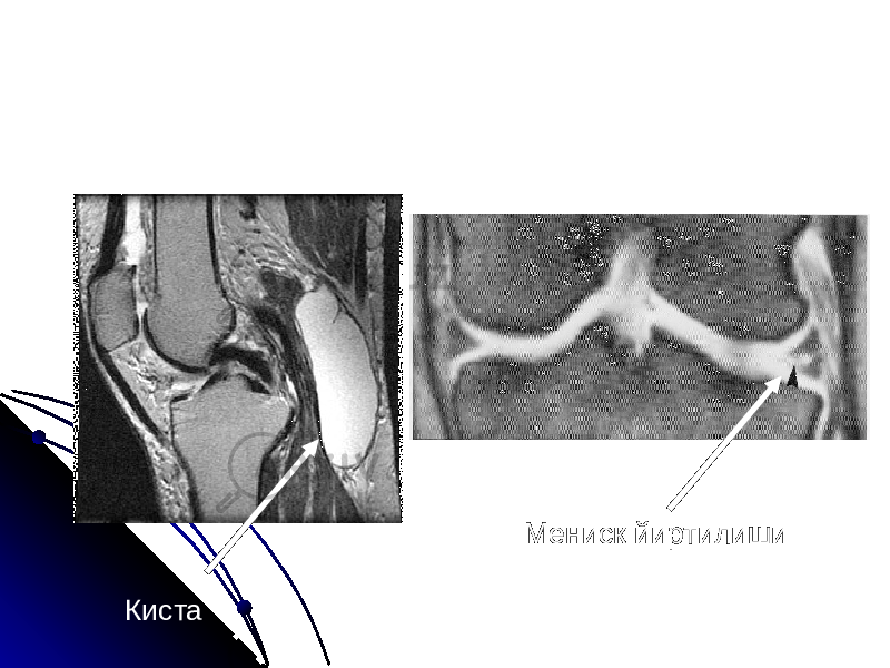 Киста Мениск йиртилиши 