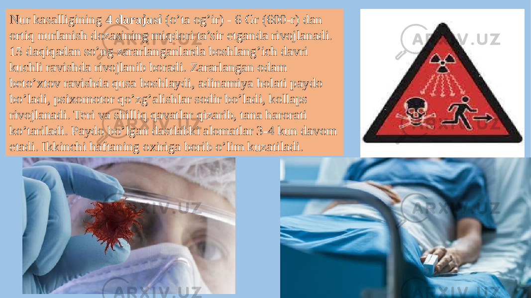 Nur kasalligining 4 darajasi (o’ta og’ir) - 6 Gr (600-r) dan ortiq nurlanish dozasining miqdori ta’sir etganda rivojlanadi. 15 daqiqadan so’ng zararlanganlarda boshlang’ich davri kuchli ravishda rivojlanib boradi. Zararlangan odam beto’xtov ravishda qusa boshlaydi, adinamiya holati paydo bo’ladi, psixomotor qo’zg’alishlar sodir bo’ladi, kollaps rivojlanadi. Teri va shilliq qavatlar qizarib, tana harorati ko’tariladi. Paydo bo’lgan dastlabki alomatlar 3-4 kun davom etadi. Ikkinchi haftaning oxiriga borib o’lim kuzatiladi. 