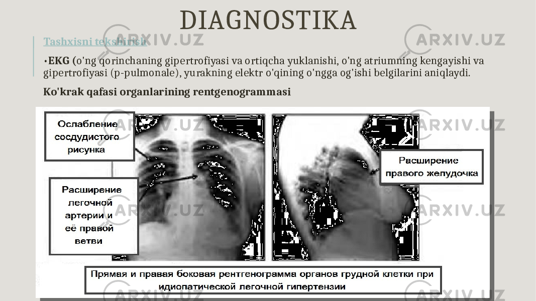 DIAGNOSTIKA Tashxisni tekshirish • EKG ( o&#39;ng qorinchaning gipertrofiyasi va ortiqcha yuklanishi, o&#39;ng atriumning kengayishi va gipertrofiyasi (p-pulmonale), yurakning elektr o&#39;qining o&#39;ngga og&#39;ishi belgilarini aniqlaydi. Ko&#39;krak qafasi organlarining rentgenogrammasi 