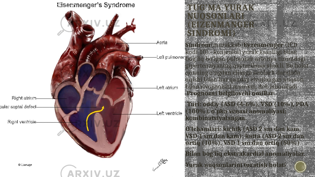 TUG&#39;MA YURAK NUQSONLARI (EIZENMANGER SINDROMI) Sindrom (murakkab) Eyzenmenger (ICD kodi 10) - konjenital yurak kasalligi bilan bog&#39;liq bo&#39;lgan pulmoner arteriya tizimidagi gipertenziyaning qaytarilmas shakli. Bu holat qonning o&#39;ngdan chapga sezilarli darajada oqishi bilan har qanday rivojlangan nuqson bilan rivojlanishi mumkin, deb ishoniladi Prognozni belgilovchi omillar : Turi: oddiy (ASD (4-6%), VSD (10%), PDA (100%), o&#39;pka venasi anomaliyasi; kombinatsiyalangan. O&#39;lchamlari: kichik (ASD 2 sm dan kam, VSD 1 sm dan kam); katta (ASD 2 sm dan ortiq (10%), VSD 1 sm dan ortiq (50%) Bilan bog&#39;liq ekstrakardial anomaliyalar. Yurak nuqsonlarini tuzatish holati 