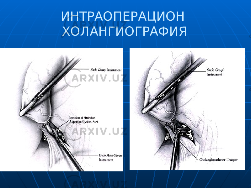  ИНТРАОПЕРАЦИОН ХОЛАНГИОГРАФИЯ 