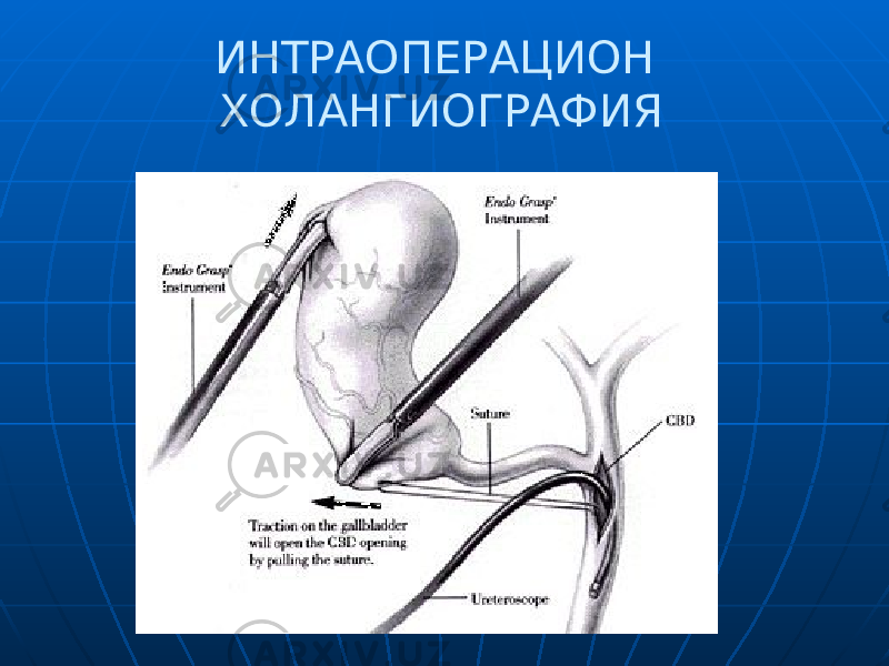  ИНТРАОПЕРАЦИОН ХОЛАНГИОГРАФИЯ 