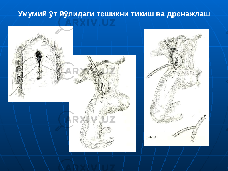 Умумий ўт йўлидаги тешикни тикиш ва дренажлаш 