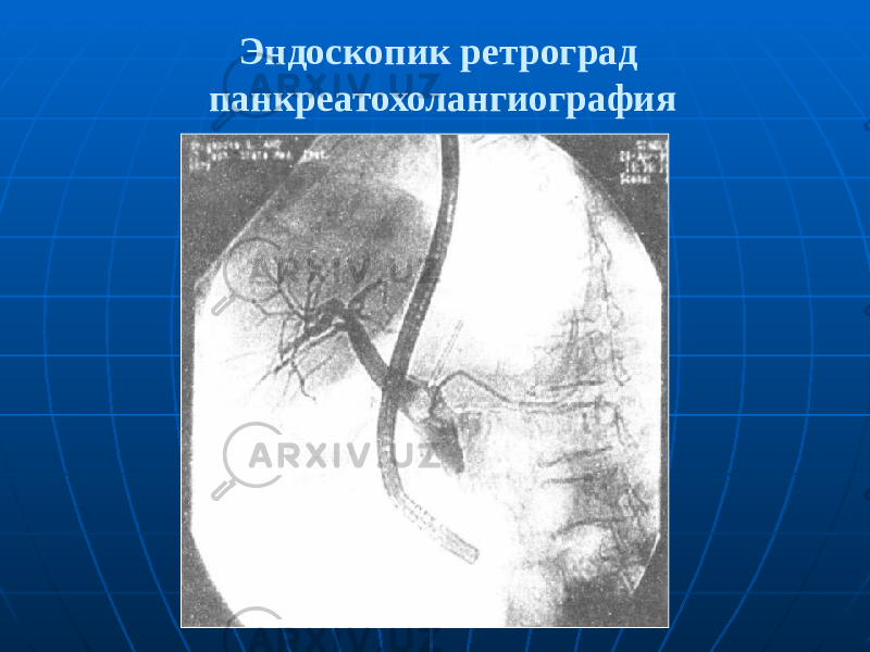Эндоскопик ретроград панкреатохолангиография 