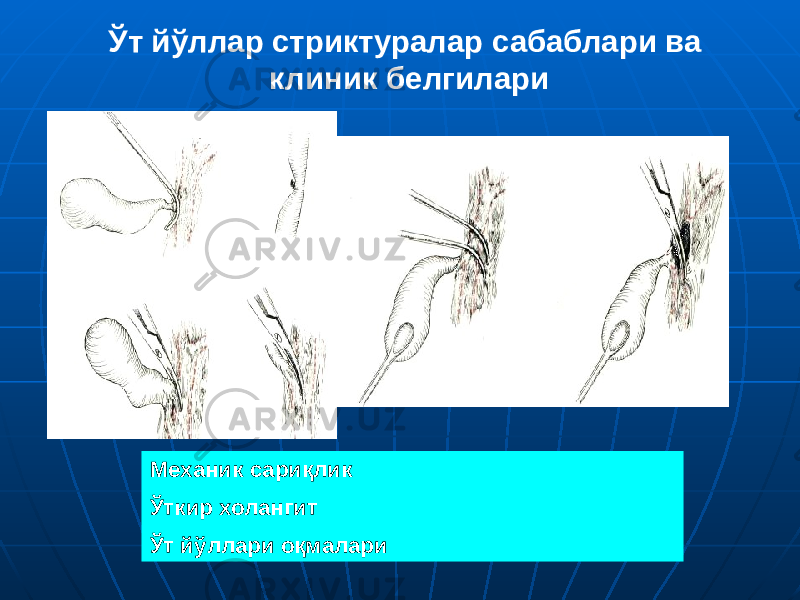 Ўт йўллар стриктуралар сабаблари ва клиник белгилари Механик сариқлик Ўткир холангит Ўт йўллари оқмалари 