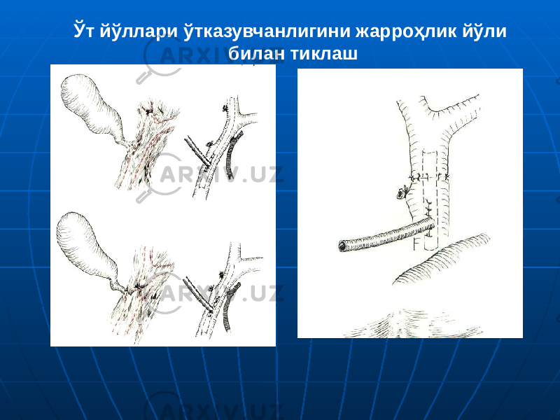 Ўт йўллари ўтказувчанлигини жарроҳлик йўли билан тиклаш 