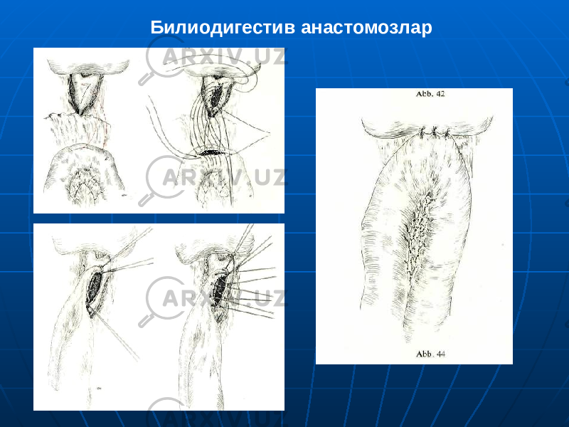 Билиодигестив анастомозлар 