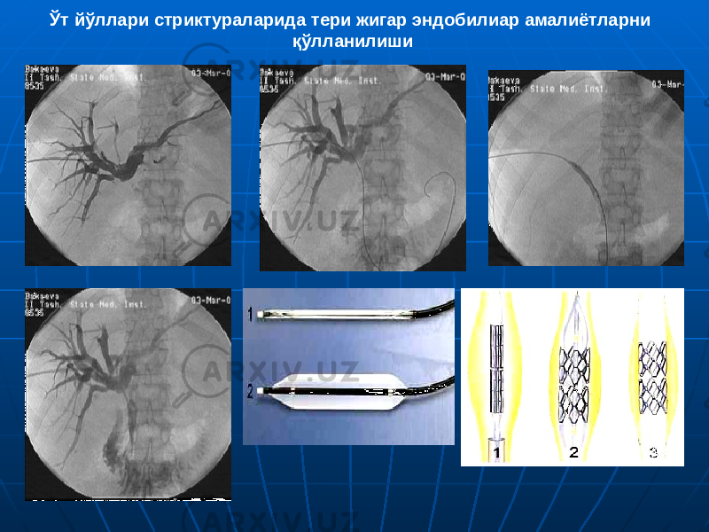 Ўт йўллари стриктураларида тери жигар эндобилиар амалиётларни қўлланилиши 