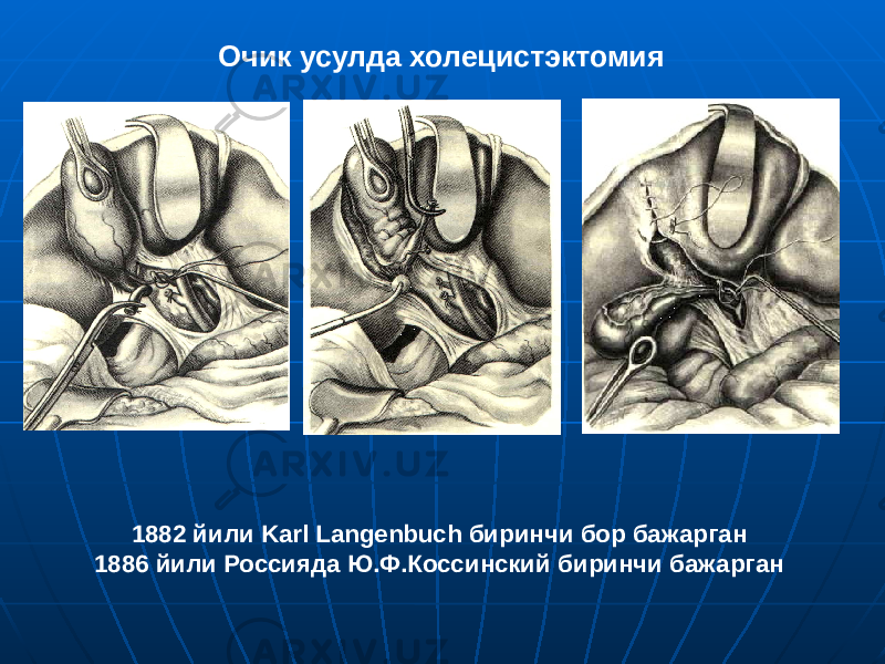 Очик усулда холецистэктомия 1882 йили Karl Langenbuch биринчи бор бажарган 1886 йили Россияда Ю.Ф.Коссинский биринчи бажарган 