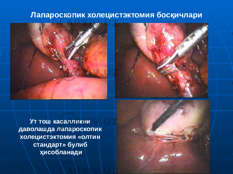 Лапароскопик холецистэктомия босқичлари Ут тош касалликни даволашда лапароскопик холецистэктомия «олтин стандарт» булиб ҳисобланади 