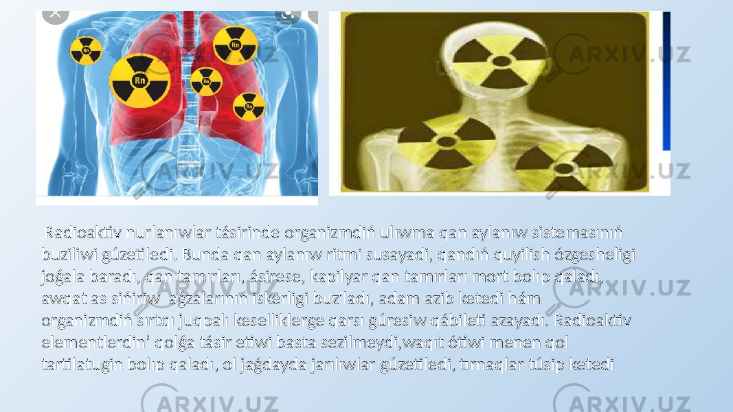  Radioaktiv nurlanıwlar tásirinde organizmdiń ulıwma qan aylanıw sistemasınıń buziliwi gúzetiledi. Bunda qan aylanıw ritmi susayadi, qandıń quyilish ózgesheligi joǵala baradı, qan tamırları, ásirese, kapilyar qan tamırları mort bolıp qaladı, awqat as sińiriw aǵzalarınıń iskerligi buz&#39;ladı, adam azib ketedi hám organizmdiń sırtqı juqpalı keselliklerge qarsı gúresiw qábileti azayadı. Radioaktiv elementlerdin’ qolǵa tásir etiwi basta sezilmeydi,waqıt ótiwi menen qol tartilatugin bolıp qaladı, ol jaǵdayda jarılıwlar gúzetiledi, tırnaqlar túsip ketedi 