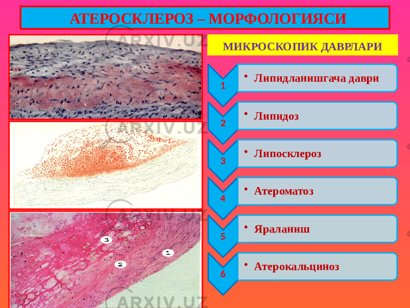 МИКРОСКОПИК ДАВРЛАРИ 1 • Липидланишгача даври 2 • Липидоз 3 • Липосклероз 4 • Атероматоз 5 • Яраланиш 6 • Атерокальциноз АТЕРОСКЛЕРОЗ – МОРФОЛОГИЯСИ 