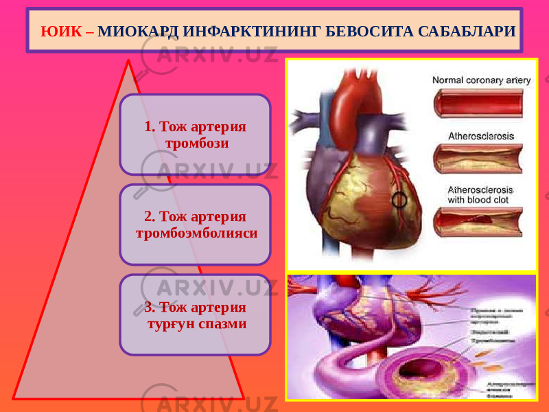 1. Тож артерия тромбози 2. Тож артерия тромбоэмболияси 3. Тож артерия турғун спазми ЮИК – МИОКАРД ИНФАРКТИНИНГ БЕВОСИТА САБАБЛАРИ 