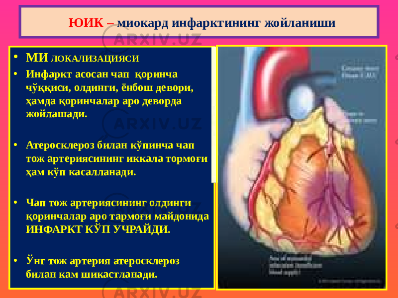 • МИ ЛОКАЛИЗАЦИЯСИ • Инфаркт асосан чап қоринча чўққиси, олдинги, ёнбош девори, ҳамда қоринчалар аро деворда жойлашади. • Атеросклероз билан кўпинча чап тож артериясининг иккала тормоғи ҳам кўп касалланади. • Чап тож артериясининг олдинги қоринчалар аро тармоғи майдонида ИНФАРКТ КЎП УЧРАЙДИ. • Ўнг тож артерия атеросклероз билан кам шикастланади. ЮИК – миокард инфарктининг жойланиши 