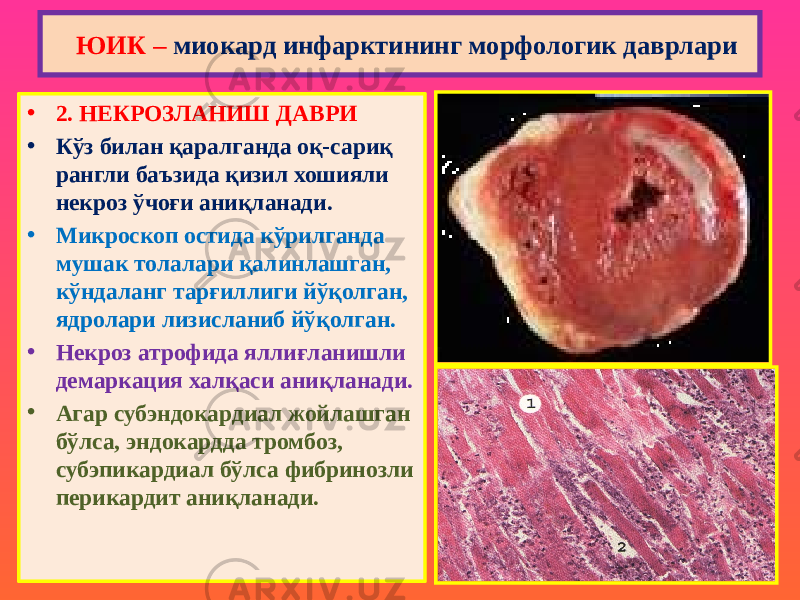 • 2. НЕКРОЗЛАНИШ ДАВРИ • Кўз билан қаралганда оқ-сариқ рангли баъзида қизил хошияли некроз ўчоғи аниқланади. • Микроскоп остида кўрилганда мушак толалари қалинлашган, кўндаланг тарғиллиги йўқолган, ядролари лизисланиб йўқолган. • Некроз атрофида яллиғланишли демаркация халқаси аниқланади. • Агар субэндокардиал жойлашган бўлса, эндокардда тромбоз, субэпикардиал бўлса фибринозли перикардит аниқланади. ЮИК – миокард инфарктининг морфологик даврлари 