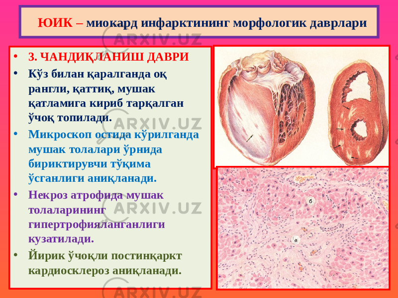 • 3. ЧАНДИҚЛАНИШ ДАВРИ • Кўз билан қаралганда оқ рангли, қаттиқ, мушак қатламига кириб тарқалган ўчоқ топилади. • Микроскоп остида кўрилганда мушак толалари ўрнида бириктирувчи тўқима ўсганлиги аниқланади. • Некроз атрофида мушак толаларининг гипертрофияланганлиги кузатилади. • Йирик ўчоқли постинқаркт кардиосклероз аниқланади. ЮИК – миокард инфарктининг морфологик даврлари 