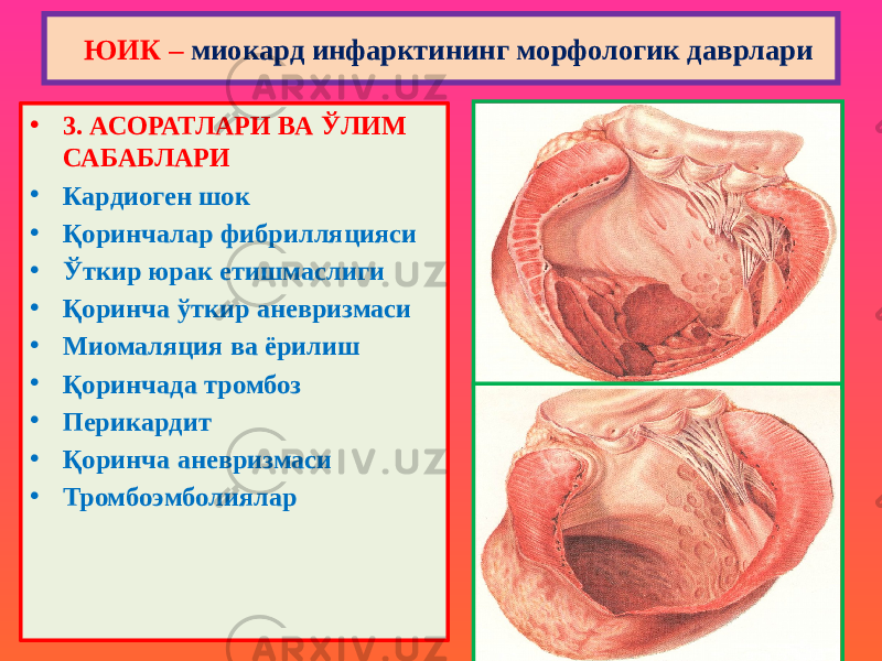 • 3. АСОРАТЛАРИ ВА ЎЛИМ САБАБЛАРИ • Кардиоген шок • Қоринчалар фибрилляцияси • Ўткир юрак етишмаслиги • Қоринча ўткир аневризмаси • Миомаляция ва ёрилиш • Қоринчада тромбоз • Перикардит • Қоринча аневризмаси • Тромбоэмболиялар ЮИК – миокард инфарктининг морфологик даврлари 