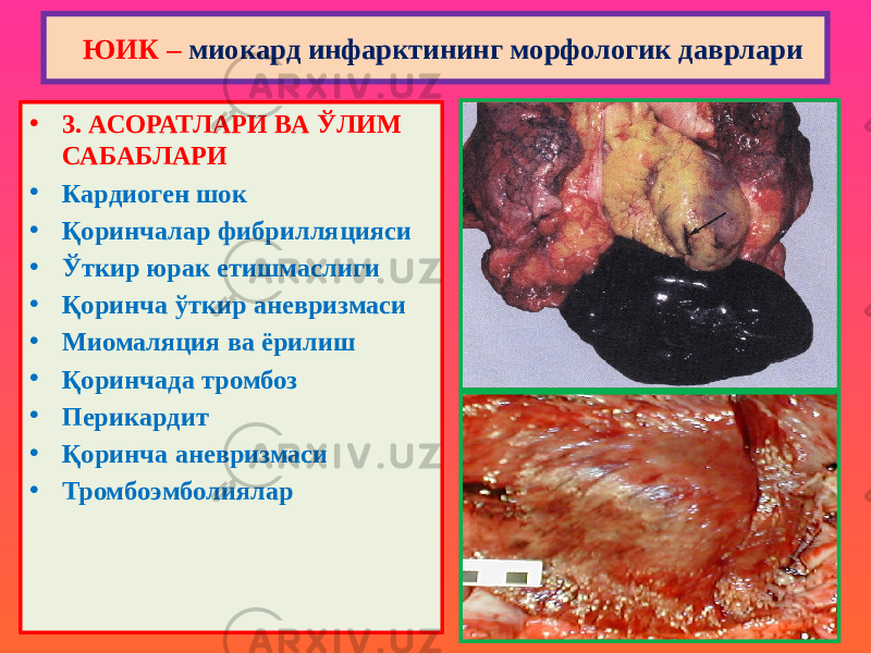 • 3. АСОРАТЛАРИ ВА ЎЛИМ САБАБЛАРИ • Кардиоген шок • Қоринчалар фибрилляцияси • Ўткир юрак етишмаслиги • Қоринча ўткир аневризмаси • Миомаляция ва ёрилиш • Қоринчада тромбоз • Перикардит • Қоринча аневризмаси • Тромбоэмболиялар ЮИК – миокард инфарктининг морфологик даврлари 