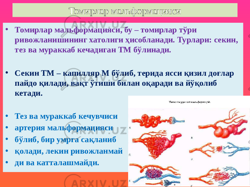 Томирлар мальформацияси • Томирлар мальформацияси, бу – томирлар тўри ривожланишининг хатолиги ҳисобланади. Турлари: секин, тез ва мураккаб кечадиган ТМ бўлинади. • Секин ТМ – капилляр М бўлиб, терида ясси қизил доғлар пайдо қилади, вақт ўтиши билан оқаради ва йўқолиб кетади. • Тез ва мураккаб кечувчиси • артерия мальформацияси • бўлиб, бир умрга сақланиб • қолади, лекин ривожланмай • ди ва катталашмайди. 