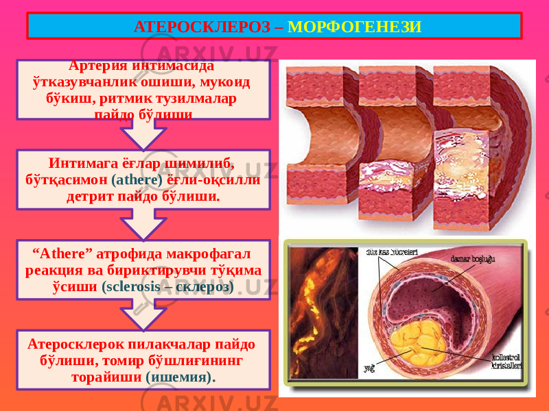 Атеросклерок пилакчалар пайдо бўлиши, томир бўшлиғининг торайиши (ишемия).“ Аthere” атрофида макрофагал реакция ва бириктирувчи тўқима ўсиши (sclerosis – склероз)Интимага ёғлар шимилиб, бўтқасимон (athere) ёғли-оқсилли детрит пайдо бўлиши. Артерия интимасида ўтказувчанлик ошиши, мукоид бўкиш, ритмик тузилмалар пайдо бўлиши АТЕРОСКЛЕРОЗ – МОРФОГЕНЕЗИ 