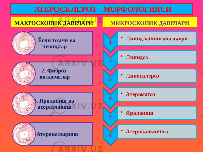 МАКРОСКОПИК ДАВРЛАРИ 1. Ёғли томчи ва чизиқлар 2. Фиброз пилакчалар 3. Яраланиш ва асоратланиш 4. Атерокальциноз МИКРОСКОПИК ДАВРЛАРИ 1 • Липидланишгача даври 2 • Липидоз 3 • Липосклероз 4 • Атероматоз 5 • Яраланиш 6 • Атерокальциноз АТЕРОСКЛЕРОЗ – МОРФОЛОГИЯСИ 