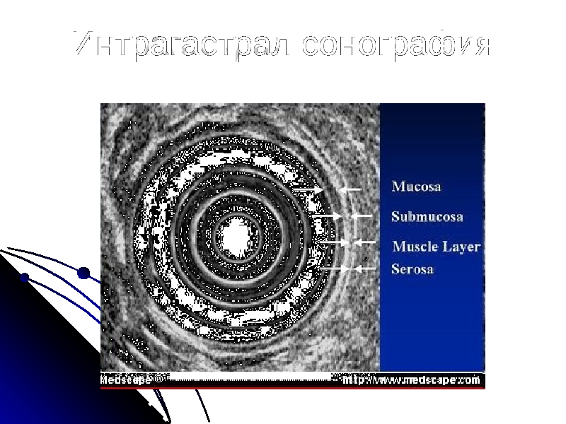 Интрагастрал сонография 