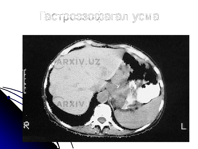 Гастроэзофагал усма У 